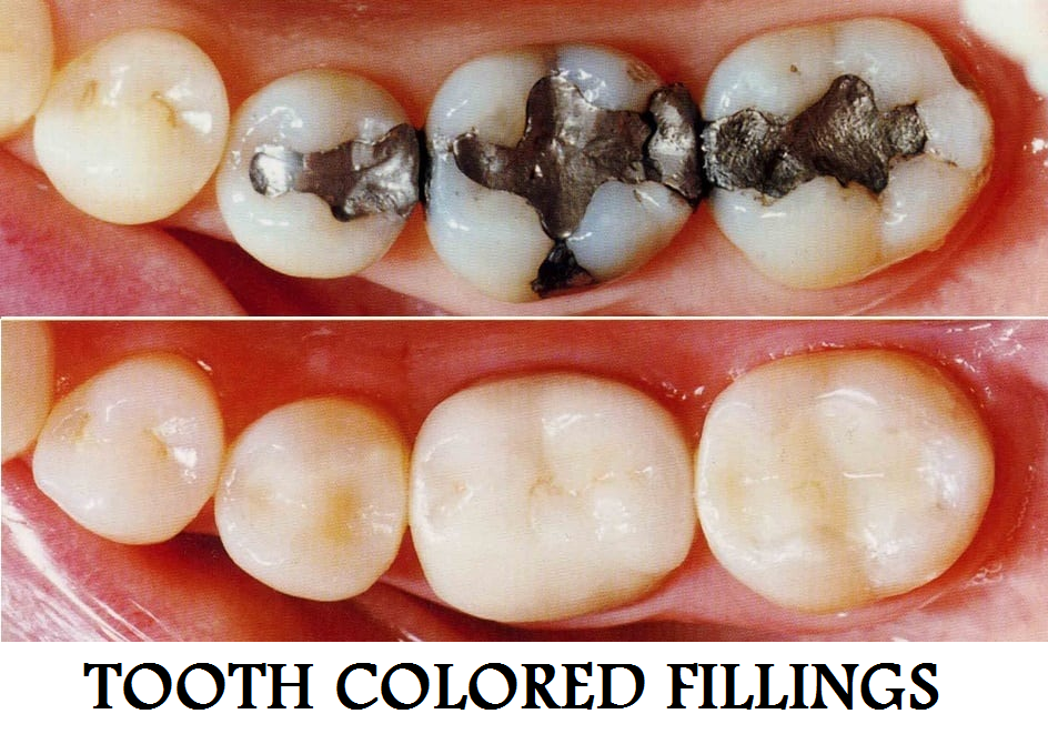 TOOTH COLOURED FILLING